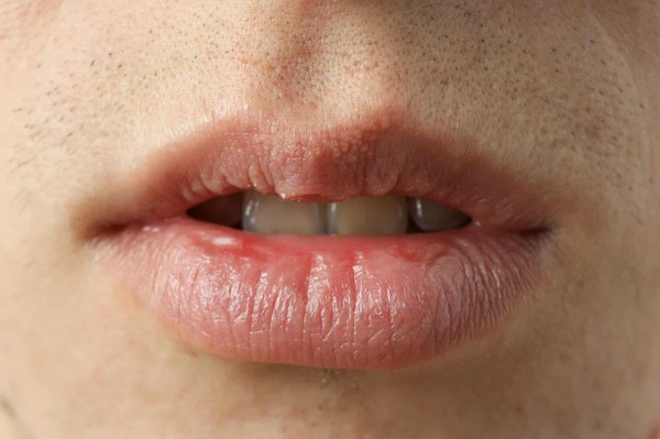 Comment les centres de denturologie traitent-ils les cas de xérostomie (sécheresse buccale) ?